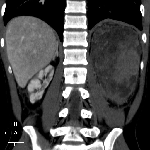 File:Aorto-left renal vein fistula (Radiopaedia 45534-49628 B 54).jpg