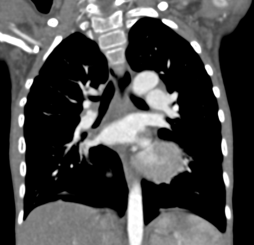 File:Aortopulmonary window, interrupted aortic arch and large PDA giving the descending aorta (Radiopaedia 35573-37074 D 41).jpg