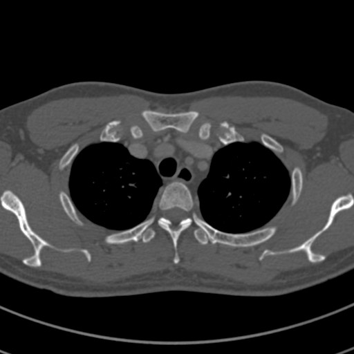 File:Apical lung mass mimic - neurogenic tumor (Radiopaedia 59918-67521 Axial bone window 15).jpg