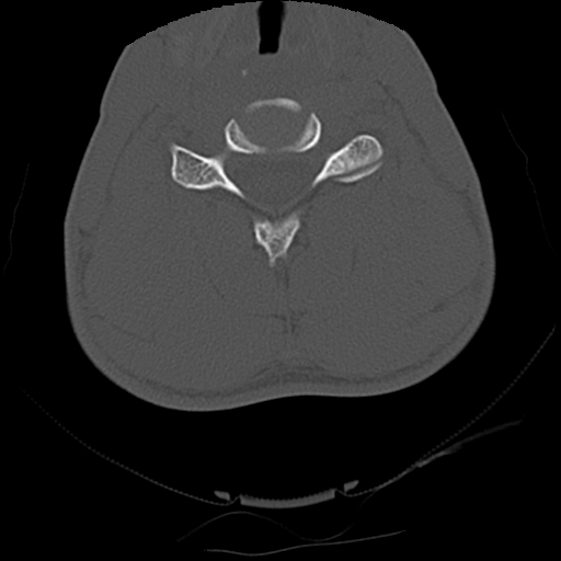 Apical pneumothorax on cervical spine CT (Radiopaedia 45343-49368 Axial bone window 56).jpg