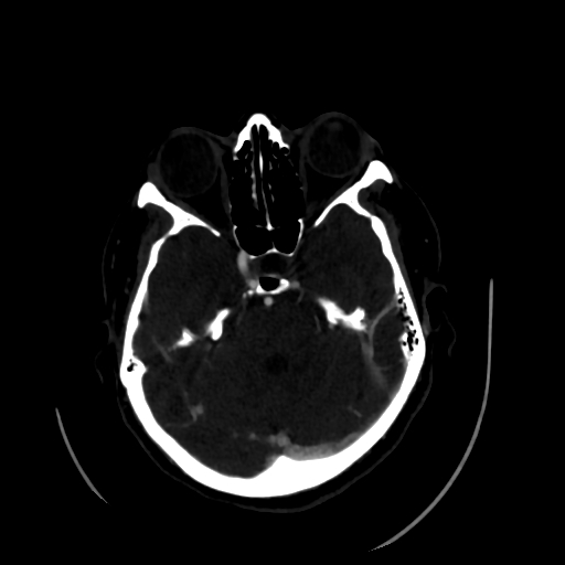 Aplasia of the internal carotid artery (Radiopaedia 61082-68960 A 22).jpg