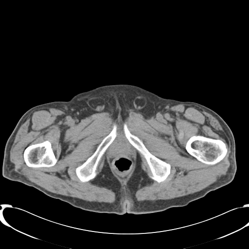 File:Appendiceal abscesses (Radiopaedia 50999-56542 Axial non-contrast 86).png