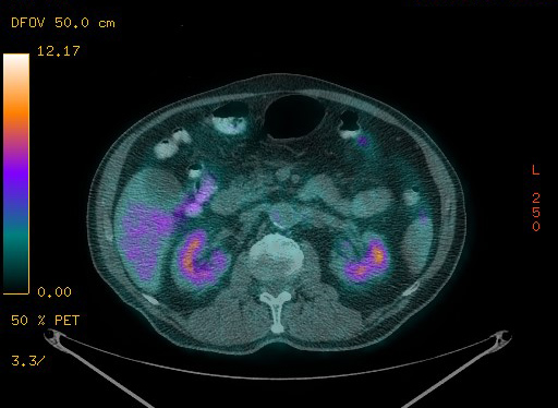 Appendiceal adenocarcinoma complicated by retroperitoneal abscess (Radiopaedia 58007-65041 Axial PET-CT 119).jpg