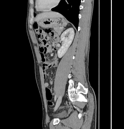 Appendiceal mucinous adenocarcinoma (Radiopaedia 66605-75922 C 45).jpg