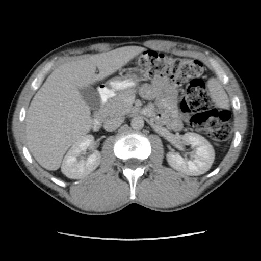 Appendicitis complicated by post-operative collection (Radiopaedia 35595-37113 A 24).jpg