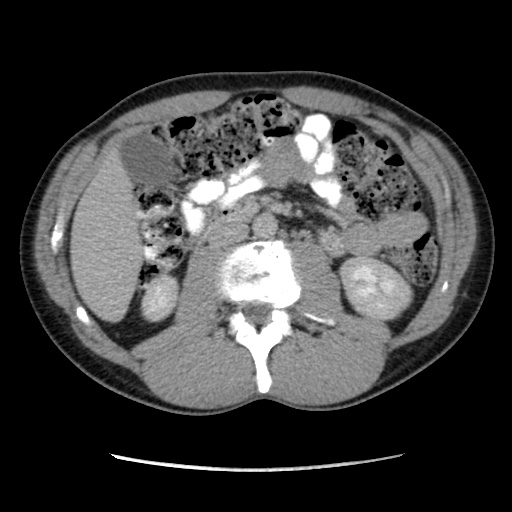 Appendicitis complicated by post-operative collection (Radiopaedia 35595-37113 A 32).jpg