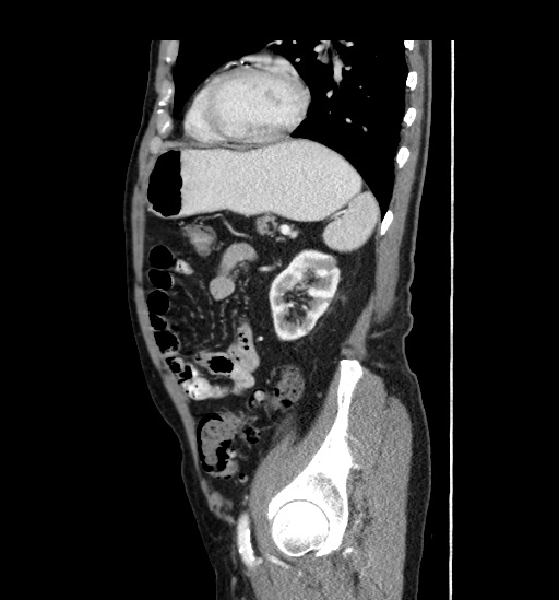 Appendicitis with localized perforation and abscess formation (Radiopaedia 49035-54130 C 47).jpg