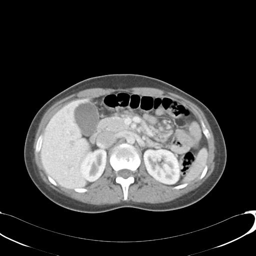 Appendicitis with minimal stranding but appendicolith (Radiopaedia 29035-29397 A 29).jpg