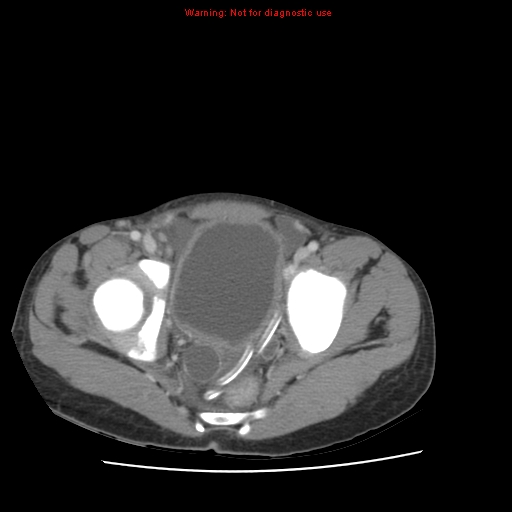 File:Appendicitis with phlegmon (Radiopaedia 9358-10046 A 64).jpg