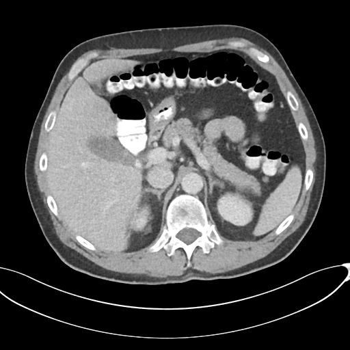Appendicitis with thickening of the terminal ileum (Radiopaedia 42432-45550 A 28).png