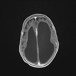 Aqueductal stenosis (Radiopaedia 73974-84802 Axial T1 C+ 103).jpg