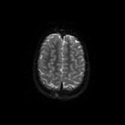 Arachnoid cyst - middle cranial fossa (Radiopaedia 67671-77088 Axial DWI 50).jpg