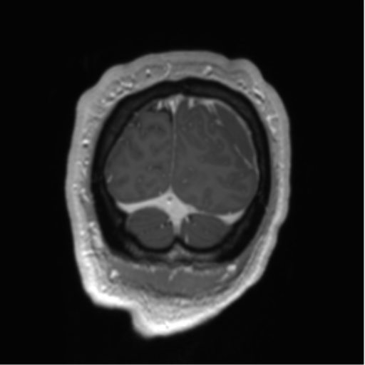Arachnoid cyst with subdural hematoma (Radiopaedia 85892-101743 Coronal T1 C+ 8).png
