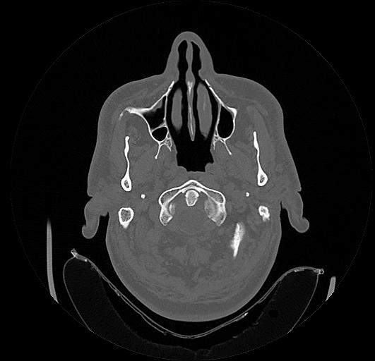 Arcuate foramen (Radiopaedia 89833-106944 Axial bone window 13).jpg