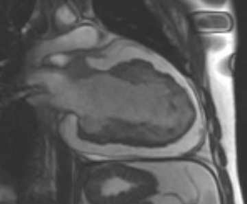 Arrhythmogenic right ventricular cardiomyopathy (Radiopaedia 69431-79307 2ch cine 18).jpg