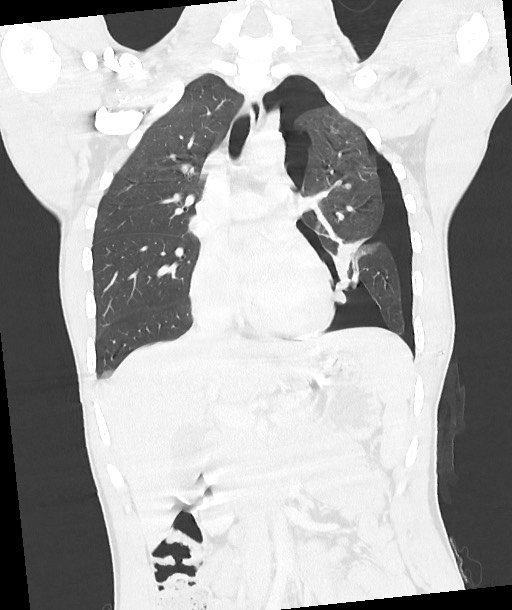 Arrow injury to the chest (Radiopaedia 85367-100975 Coronal lung window 71).jpg