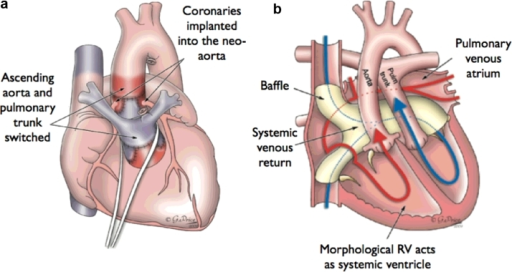 File:Arterial and atrial switch.png