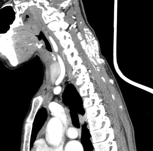 Arteriovenous malformation of the neck (Radiopaedia 53935-60062 C 54).jpg