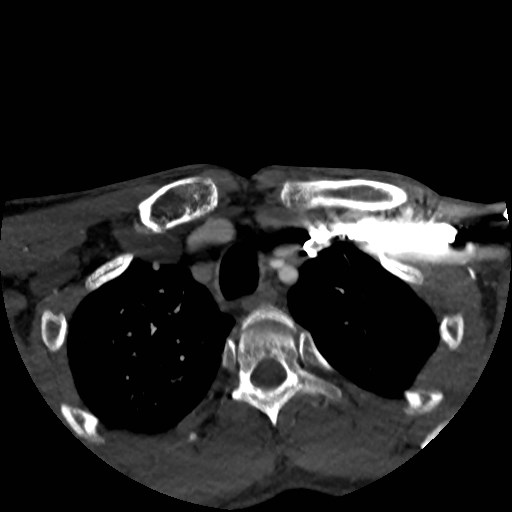 Artery of Percheron infarct (Radiopaedia 48088-52894 A 21).jpg