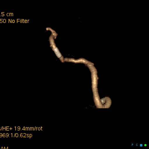 File:Artifactual basilar artery stenosis due to metallic stent (Radiopaedia 31206-31923 C 13).jpg