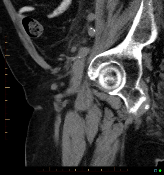 File:Artificial urethral sphincter (Radiopaedia 46937-51464 Sagittal C+ delayed 33).jpg