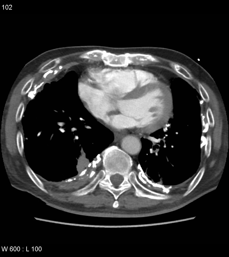 Asbestos related lung and pleural disease (Radiopaedia 14377-14301 D 38).jpg