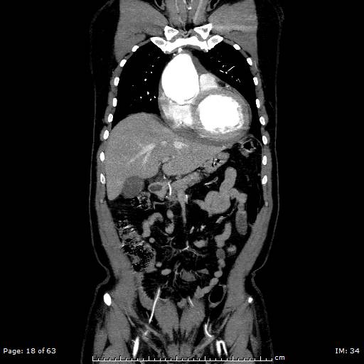 Ascending aortic aneurysm (Radiopaedia 50086-55404 B 18).jpg