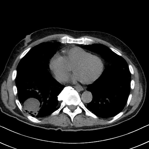 Aspergilloma on background pulmonary fibrosis (Radiopaedia 60942-68757 Axial non-contrast 39).jpg