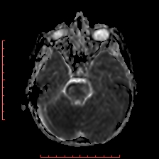 Astroblastoma (Radiopaedia 74287-85162 Axial ADC 18).jpg