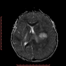 Astroblastoma (Radiopaedia 74287-85162 Axial ADC 36).jpg