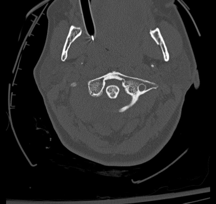 Atlanto-axial subluxation-dislocation (Radiopaedia 29659-30185 Axial bone window 25).jpg