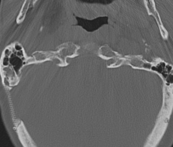 Atlanto-axial subluxation (Radiopaedia 36610-38176 Axial bone window 9).png