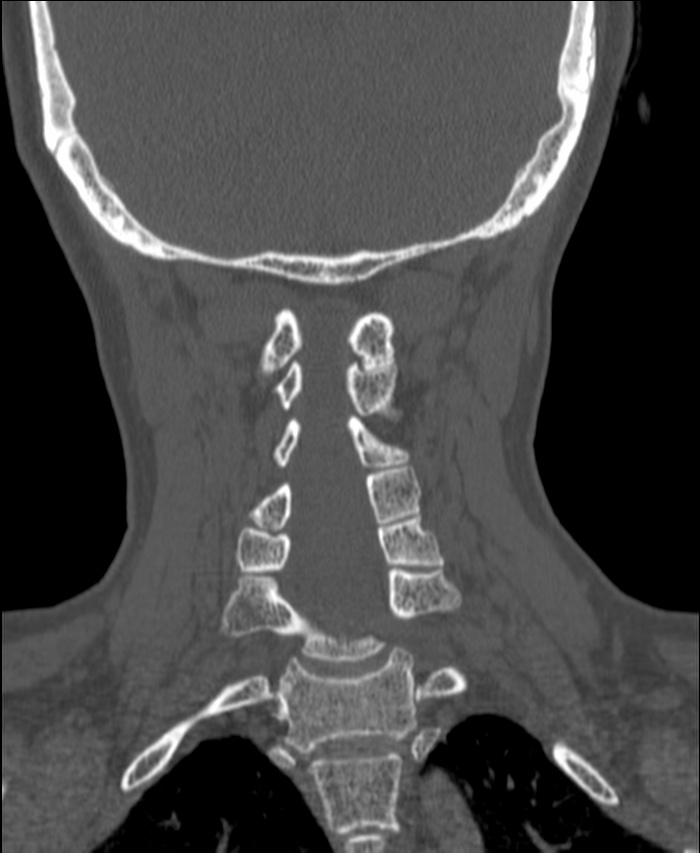 Atlanto-occipital assimilation with basilar invagination (Radiopaedia 70122-80188 Coronal bone window 149).jpg