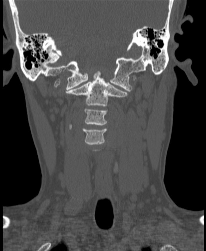 Atlanto-occipital assimilation with basilar invagination (Radiopaedia 70122-80188 Coronal bone window 77).jpg
