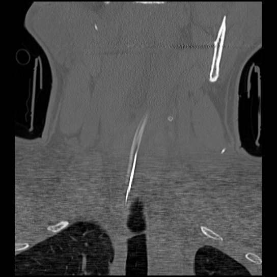 Atlanto-occipital dissociation injury (Radiopaedia 29274-29698 Coronal bone window 36).png