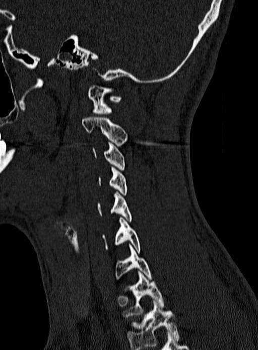 Atlantoaxial subluxation (Radiopaedia 44681-48450 Sagittal bone window 132).jpg