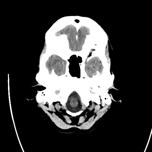 File:Atretic encephalocoele with inferior vermis hypoplasia (Radiopaedia 30443-31107 A 4).jpg
