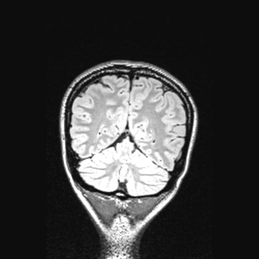 Atretic encephalocoele with inferior vermis hypoplasia (Radiopaedia 30443-31108 Coronal FLAIR 46).jpg