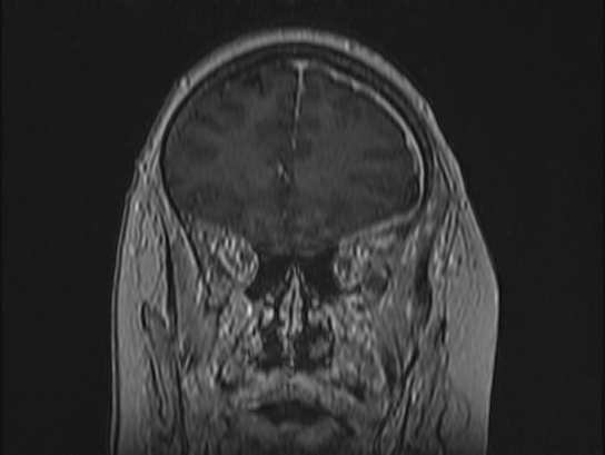 Atypical meningioma (Radiopaedia 62985-71406 Coronal T1 C+ 28).jpg
