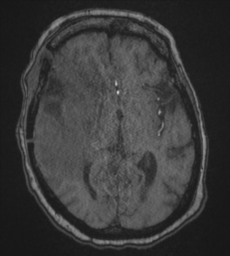 Atypical meningioma (WHO Grade II) (Radiopaedia 54742-60981 Axial MRA 49).png