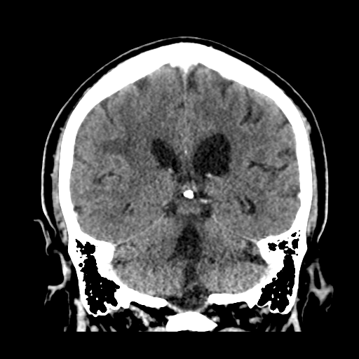 Atypical meningioma (WHO grade II) with brain invasion (Radiopaedia 57767-64728 Coronal C+ 40).png