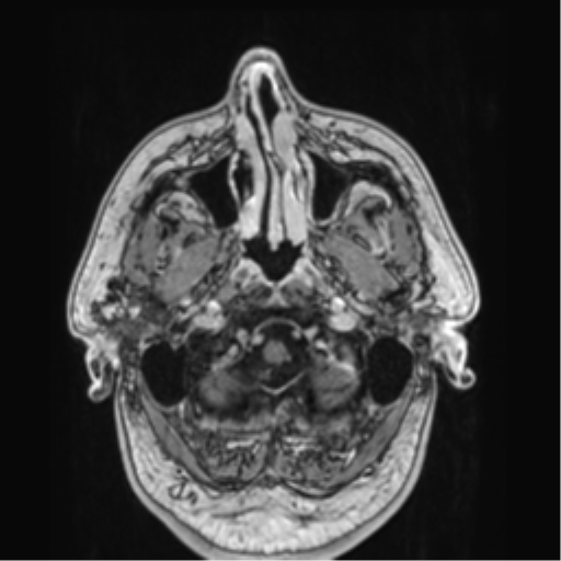 File:Atypical meningioma (WHO grade II) with brain invasion (Radiopaedia 57767-64729 Axial T1 C+ 3).png