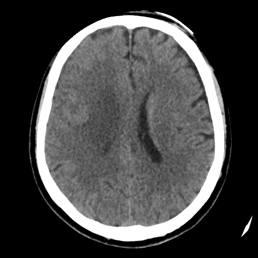 Atypical meningioma (WHO grade II) with osseous invasion (Radiopaedia 53654-59715 Axial non-contrast 33).png