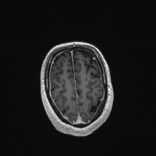 Atypical meningioma (grade II) - en plaque (Radiopaedia 29633-30147 Axial T1 C+ 153).jpg
