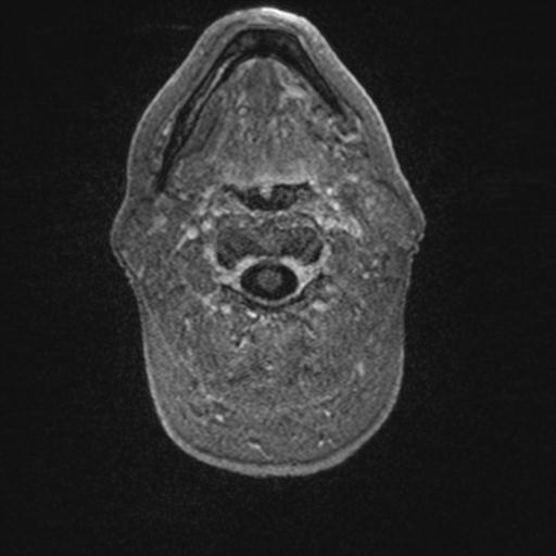 Atypical meningioma (grade II) - en plaque (Radiopaedia 29633-30147 Axial T1 C+ 8).jpg