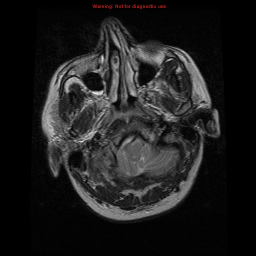 File:Atypical meningioma - grade II (Radiopaedia 13303-13305 Axial T2 3).jpg