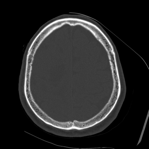 Atypical meningioma with skull invasion (Radiopaedia 34357-35649 Axial bone window 63).png