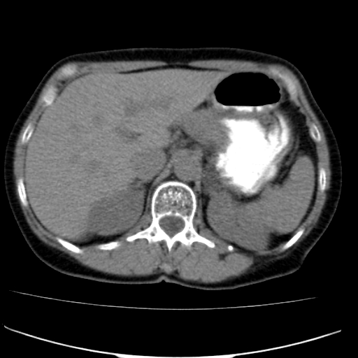 File:Atypical renal cyst (Radiopaedia 17536-17251 non-contrast 6).jpg