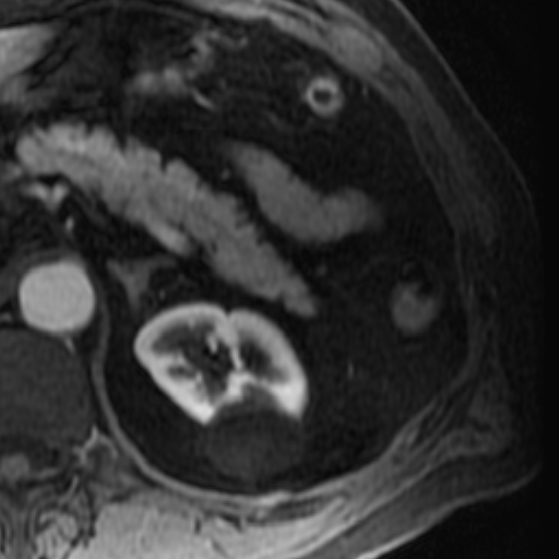 File:Atypical renal cyst on MRI (Radiopaedia 17349-17046 C 8).jpg