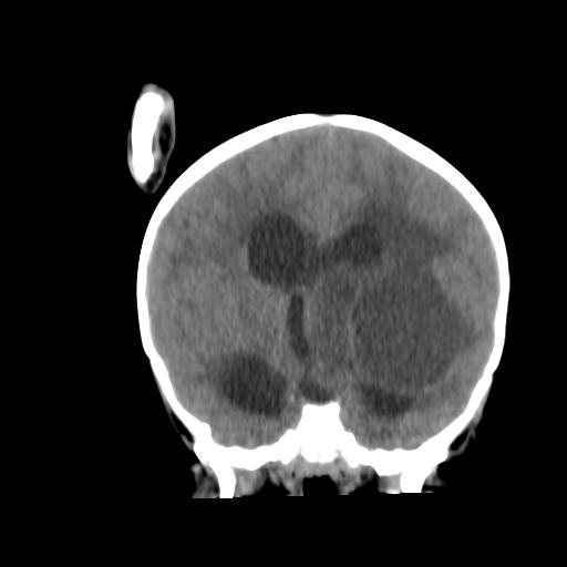 Atypical teratoid rhabdoid tumor (AT-RT) (Radiopaedia 85823-101654 Coronal non-contrast 25).jpg